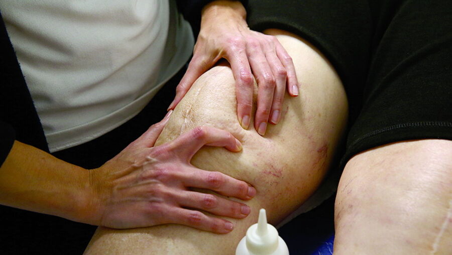 Fisioterapia ajuda, de acordo com os especialistas, na recuperação após uma intervenção minimamente invasiva ao joelho. É comum a perda muscular durante a recuperação